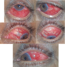 Fungal nodular scleritis