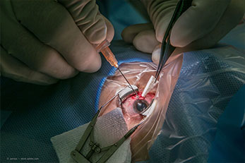 Glaucoma surgery