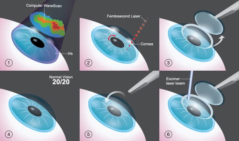 lasik_FEMTOLASIK