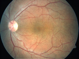 leptospiral panuveitis after