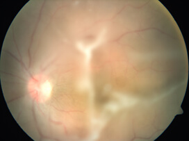 leptospiral