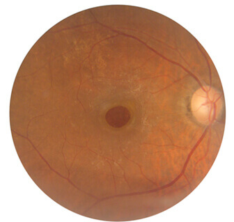 macular hole