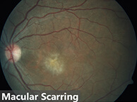 Macular scarring