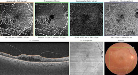 OCT Angiogram