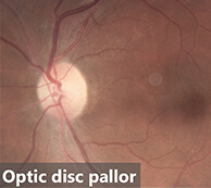Optic-disc pallor