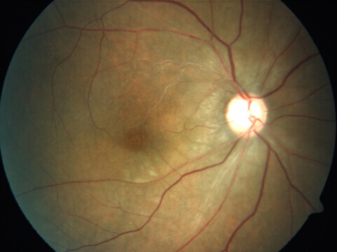 Patient after Vitrectomy