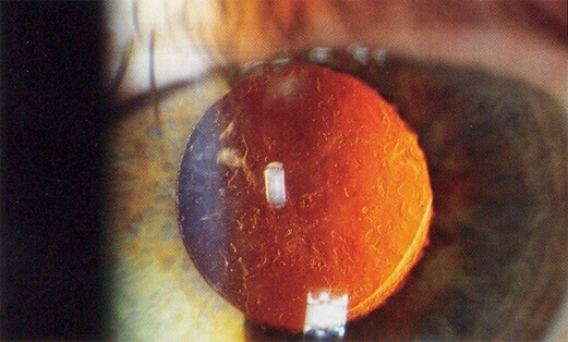 Posterior capsule
