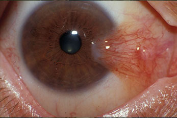 Pterygium