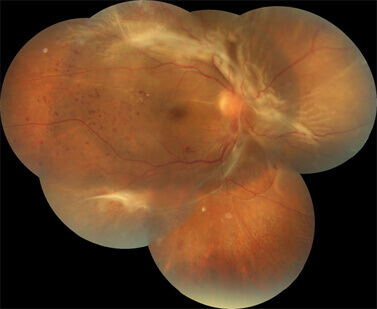 Fundus picture