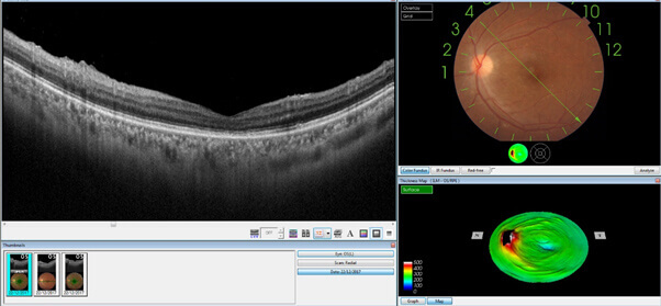 OCT scan report
