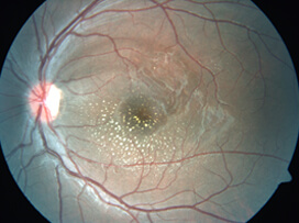 Rickettsial retinitis after