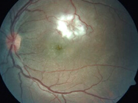Rickettsial retinitis