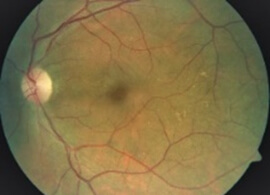 tuberculous optic after