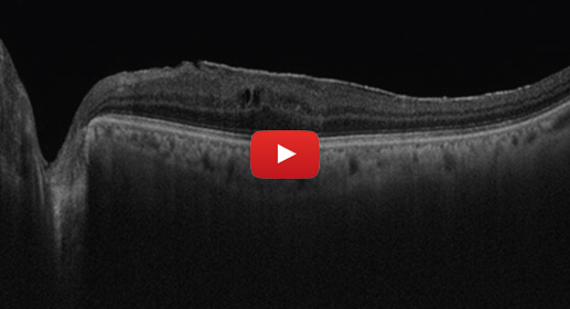 macular-pucker