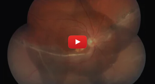 retinal-detachment