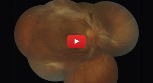 retinal-detachment