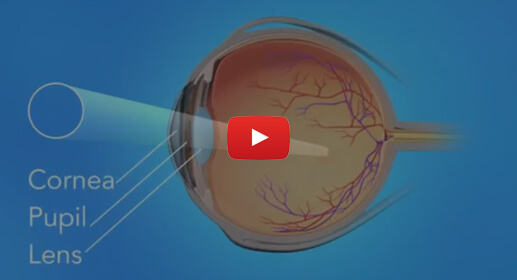 retinal-detachment