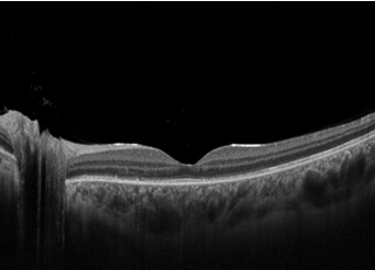 vogt-koyanagi-harada-syndrome after
