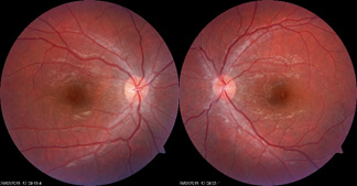 vogt-koyanagi-harada-syndrome after