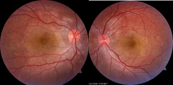 VOGT koyanagi harada syndrome