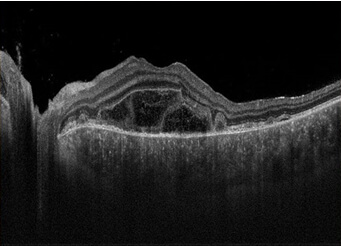 vogt-koyanagi-harada-syndrome