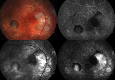 Wet AMD